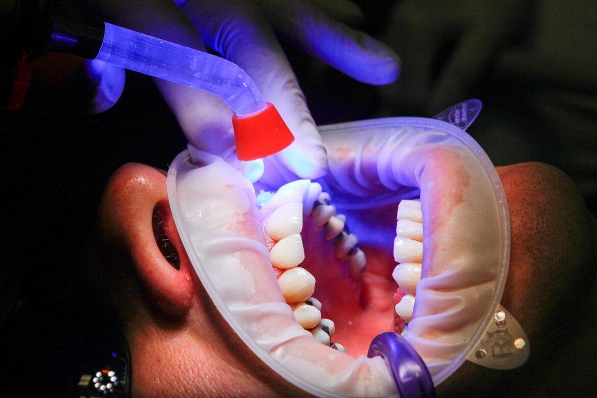 How Dental Veneers Can Transform Your Lifestyle